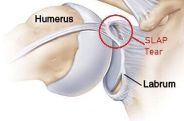 durere pe partea laterală a articulației șoldului